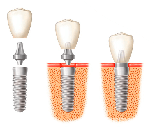 Implantate
